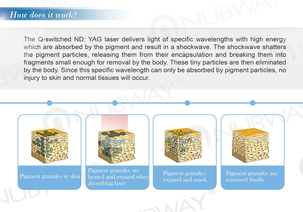 Laser Tattoo Removal Pigmentation Skin Tightening Q Switched Nd Yag Laser Machine