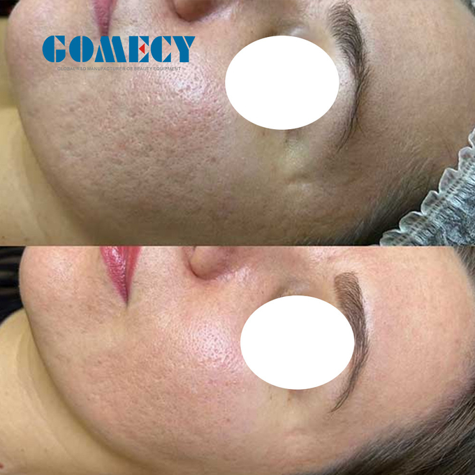 Q Switched ND Yag Laser Machine 2000W High Energy And 6 Functions 100-2000J For Remove Age Pigmented Birthmarks