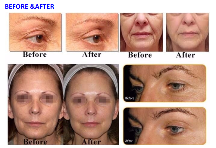 Meso Therapy Water Oxygen Jet Peel Machine Excellent Absorption Ability