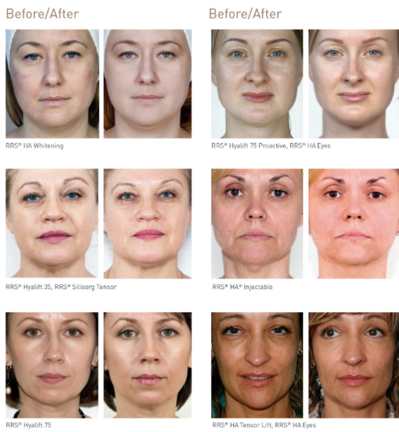 Skin brighter Meso Serum Microneedling Customized Logo Anti Aging Whitening Serum