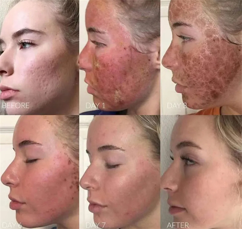 Desktop Fractional Laser Machine Scar Removal Body Skin Tightening