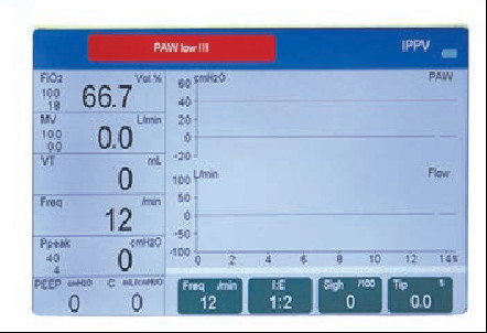 High Precision S6500 Portable Universal Anesthesia Machine 7" Screen