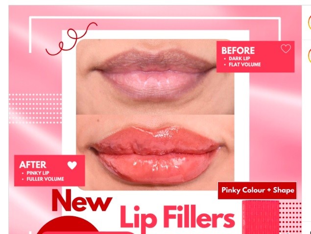 Lip Function Dermal Lip Fillers 1ml For OEM Natural Looking Plumping Lip Fillers