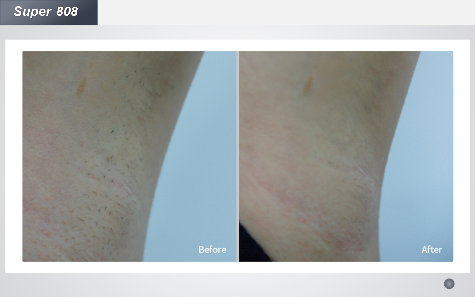 755nm 808nm 1064nm Diode Laser Hair Removal Machine Triple Wave