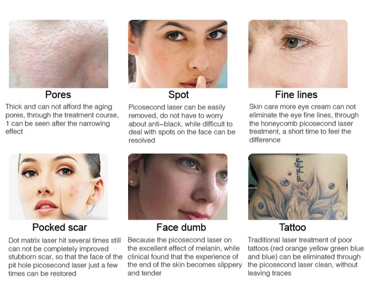 Portable Pico Second Laser Tatoo Remover Q Switched Nd Yag Picosecond Tattoo Removal Machine