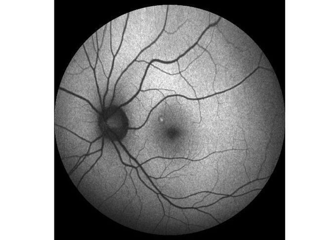 Ultra-wide Field Laser Scanning Retina Angiograph Digital Ophthalmic Equipment With Optical Zoom 100°/60°/30°