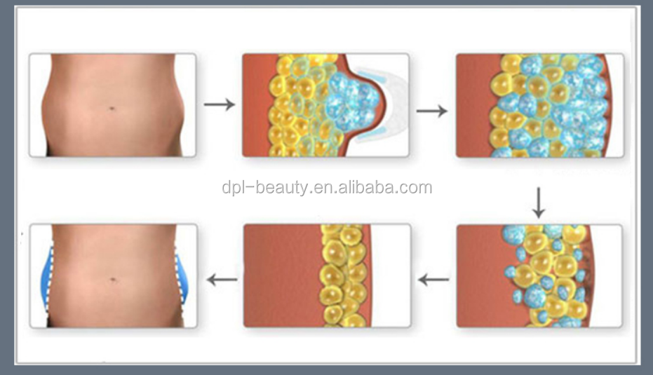 DM-55-1 Skin Tightening 360 Cryolipolysis Slimming Machine 50KHZ Anti Cellulite