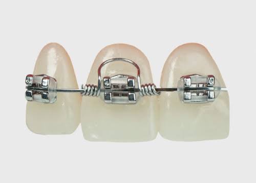 16*22 S/M/L 17*25 S/M/L 19*25 S/M/L Dental Orthodontic Torque Spring for Class II Instrument Classification
