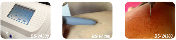 Vein Vascular removal spider vein korea vascular removal machine