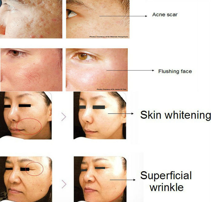 CE approved Nubway high quality 2015 big promotion fractional RF & microneedle RF device for face lifting