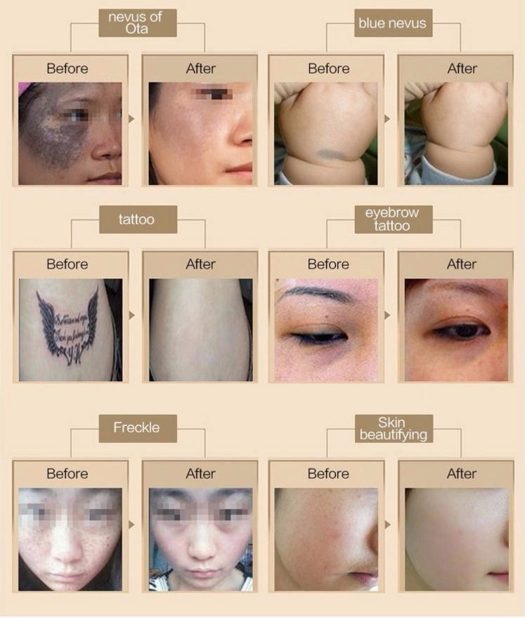 2000W CE&FDA approved all pigmentation removal picosecond laser tattoo removal cost