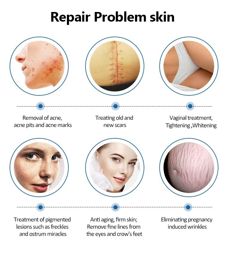 Surgical Fractional Co2 Laser Yag Laser Carbon Acne Scar Removal Wrinkle Reduction Machine