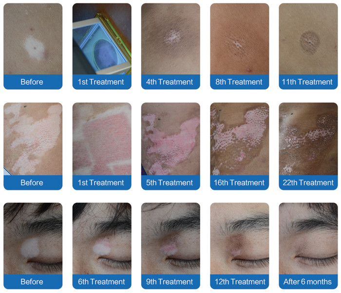 Targeted Vitiligo Laser Treatment XeCl Light 308nm