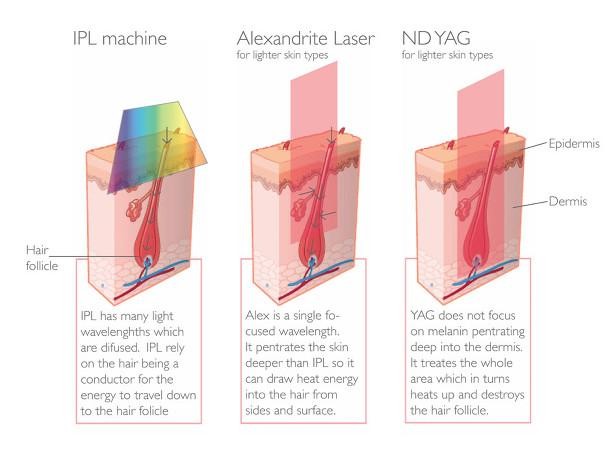 Quick ND Yag Laser Tattoo Removal Machine Tattoo Eraser Machine 1 - 10Hz Frequency