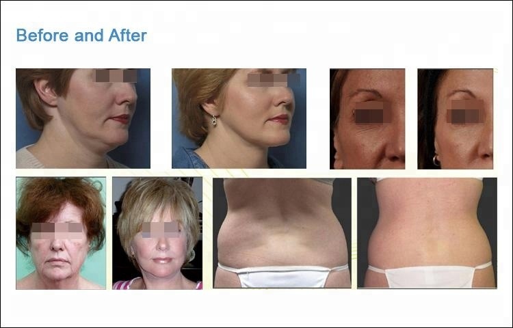 Skin Rejuvenation RF Thermage Machine Professional For Wrinkle Removal Treatment