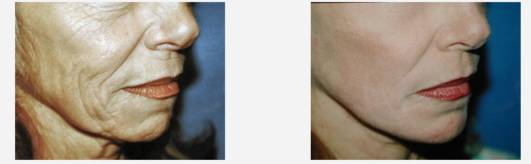 Protable Fractional Co2 Laser Treatment Machine For Skin Resurfacing / Wrinkles