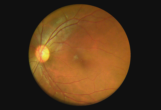 Handheld Digital Fundus Camera With True 5MP Image Resolution And 45° FOV Support 2G to 32G Files Storge