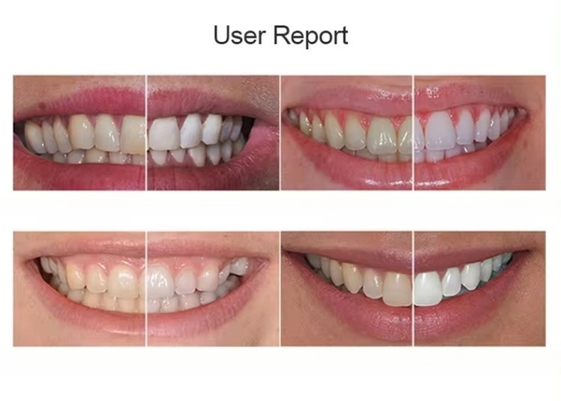 Professional Teeth Whitening Led Bleaching Lamp Dental Chair Mounted Teeth Whitening Machine