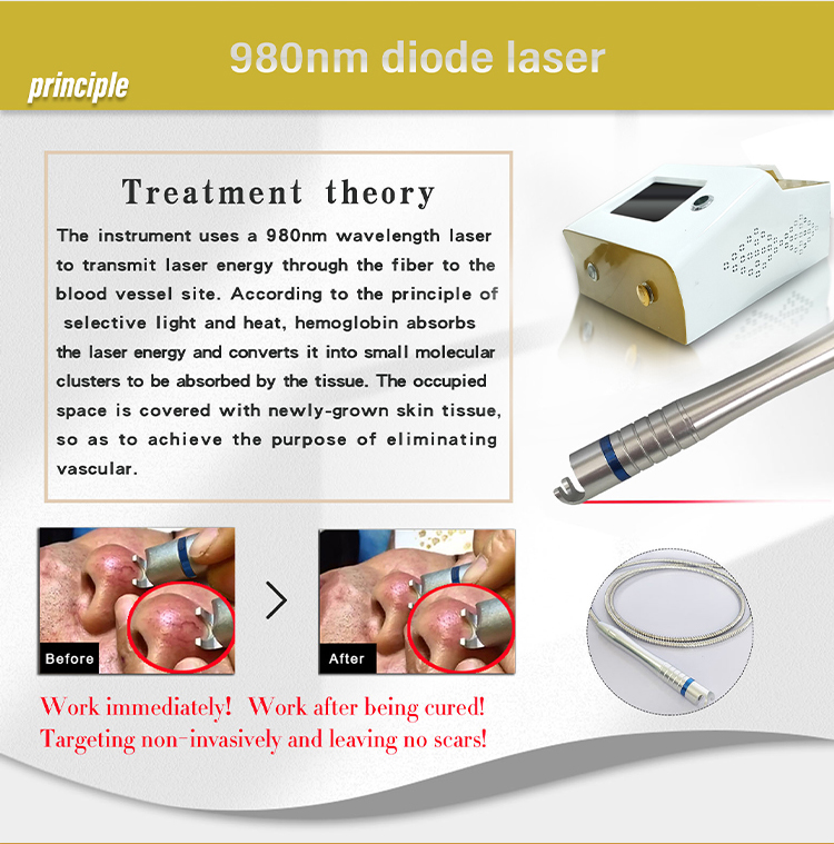 Diode Laser Spider Vein Removal Machine Air Cooling Nail Fungus Treatment 980nm