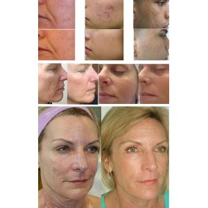 Rf Microneedle Fractional Radio Frequency Machine Face Lift Wrinkle Removal