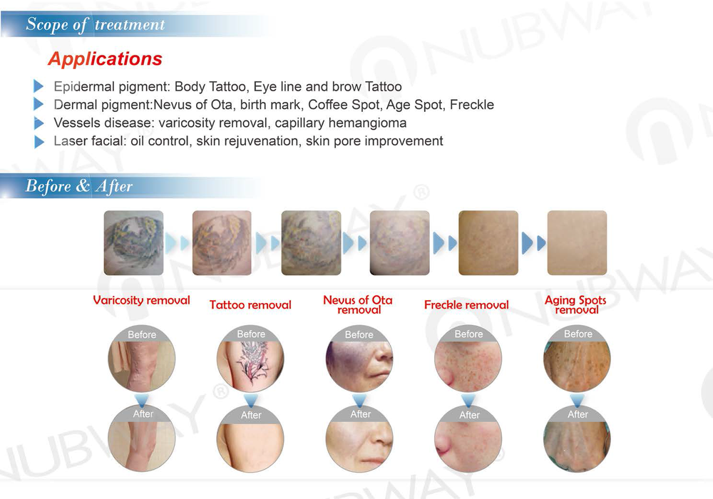 Laser Tattoo Removal Pigmentation Skin Tightening Q Switched Nd Yag Laser Machine