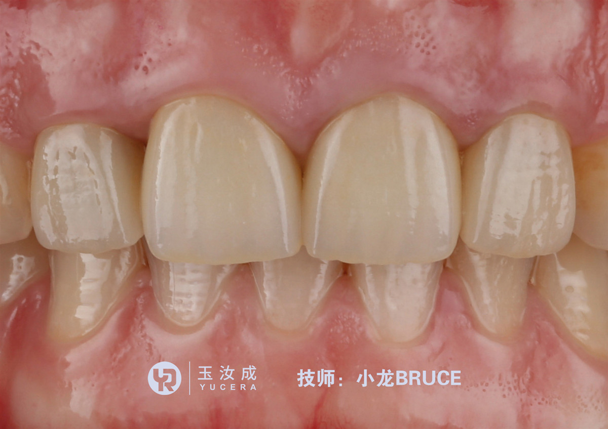 Yucera 3D Plus Multilayer Ceramic Zirconia Block 43% - 57% Translucent For CAD CAM System