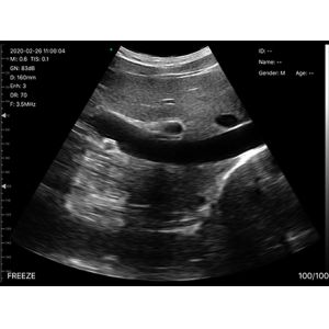 USB Convex Ultrasound Transducer Wireless Convex Array Ultrasound Probe for OB