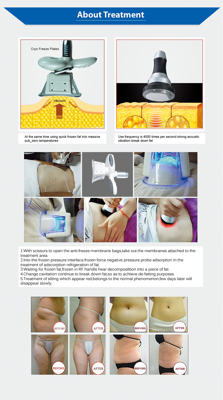 Portable 4 In 1 Cryo Fat Freezing Machine Cavitation RF For Body Sculpt