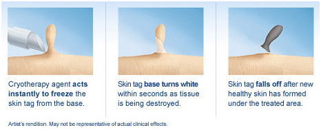 Spider vein laser removal varicose veins laser treatment machine