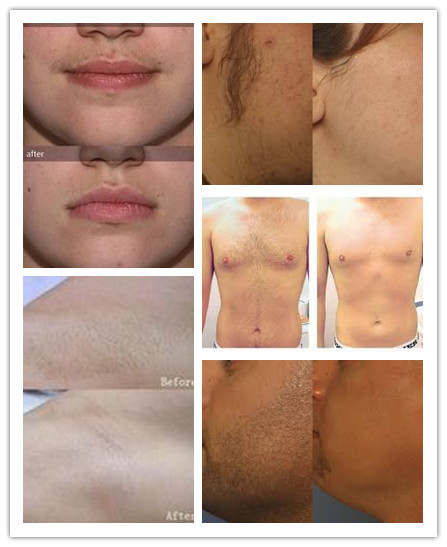 portable diode laser hair removal