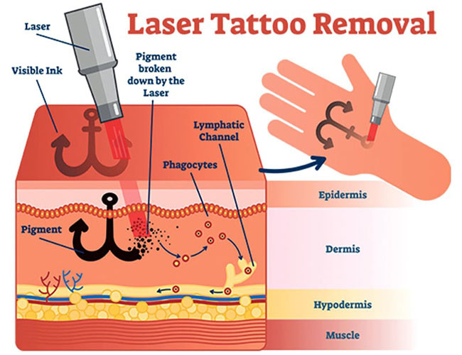 Portable 532nm 1320nm 1064nm Q Switched Nd Yag Laser Machine Tattoo Removal
