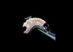 Easy Fit Cast Partial Denture Restores Chewing And Speaking Ability