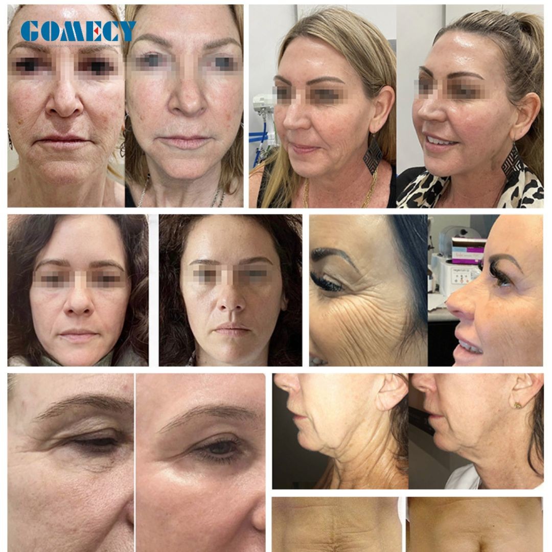 RF Microneedling Machine For Acne Sca RF Microneedle Handle Head With Cable Portable