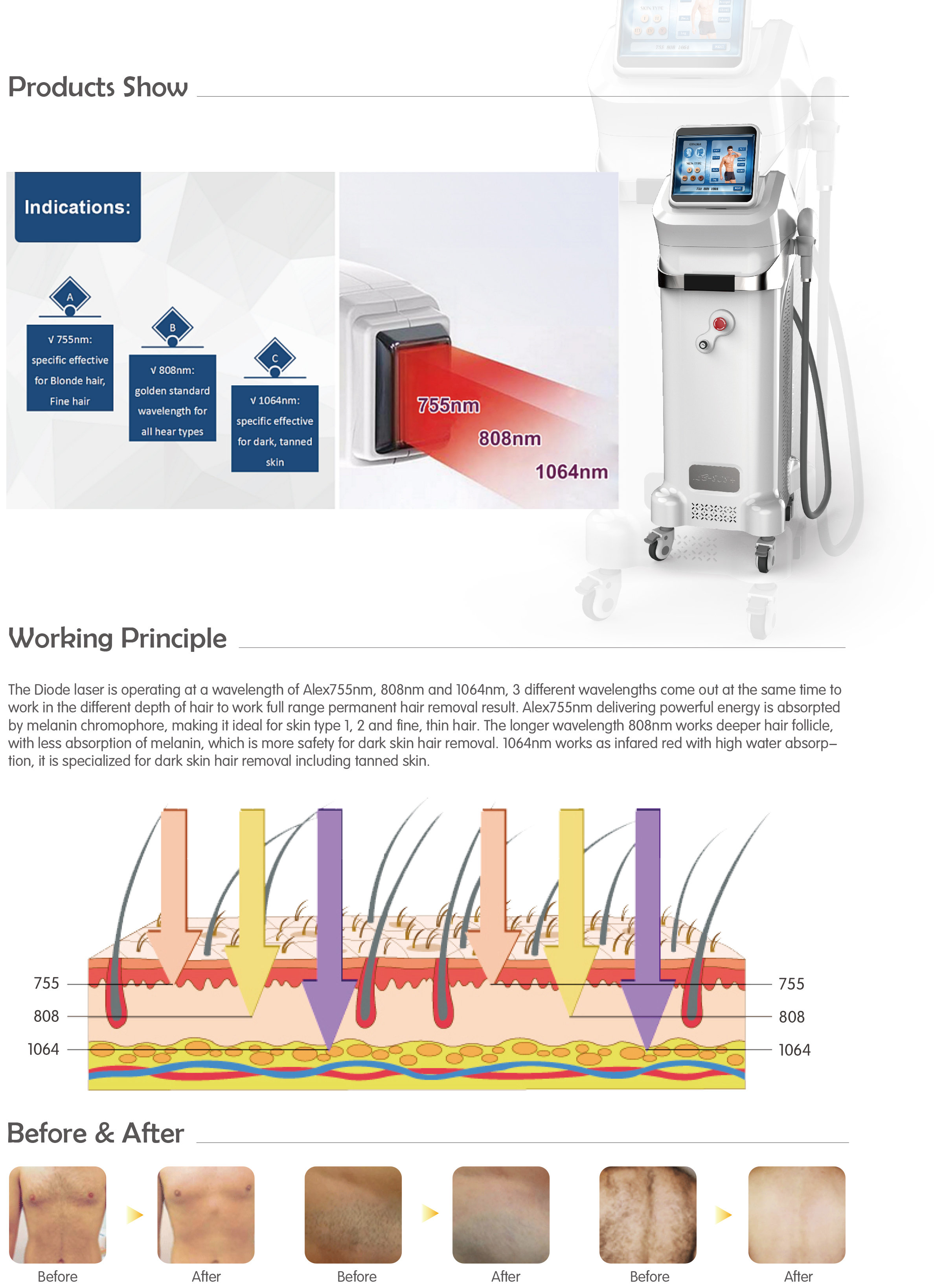 800W Germany laser bars Medical CE approved alexandrite laser hair removal