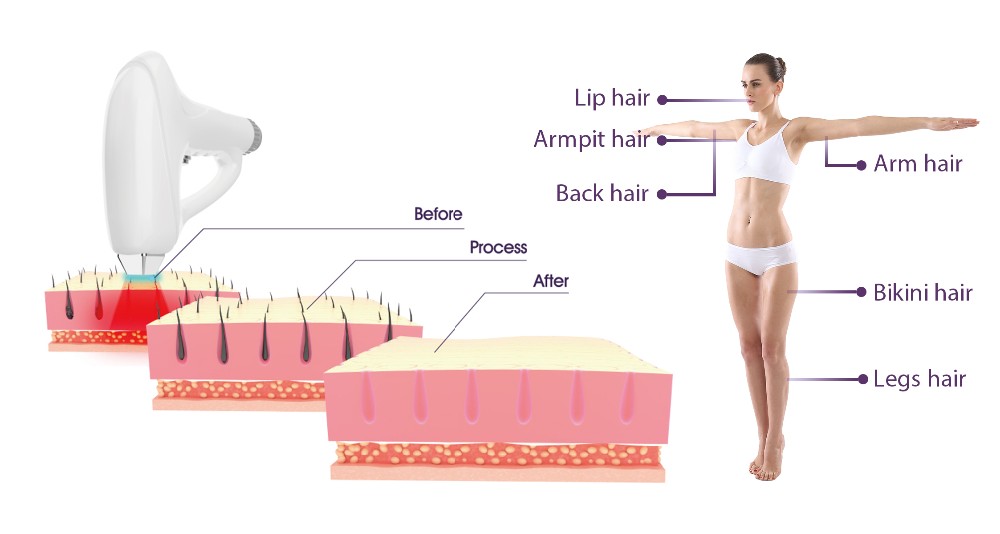 Three Wavelengths Diode Laser Hair Removal Machine 1 - 10Hz Frequency