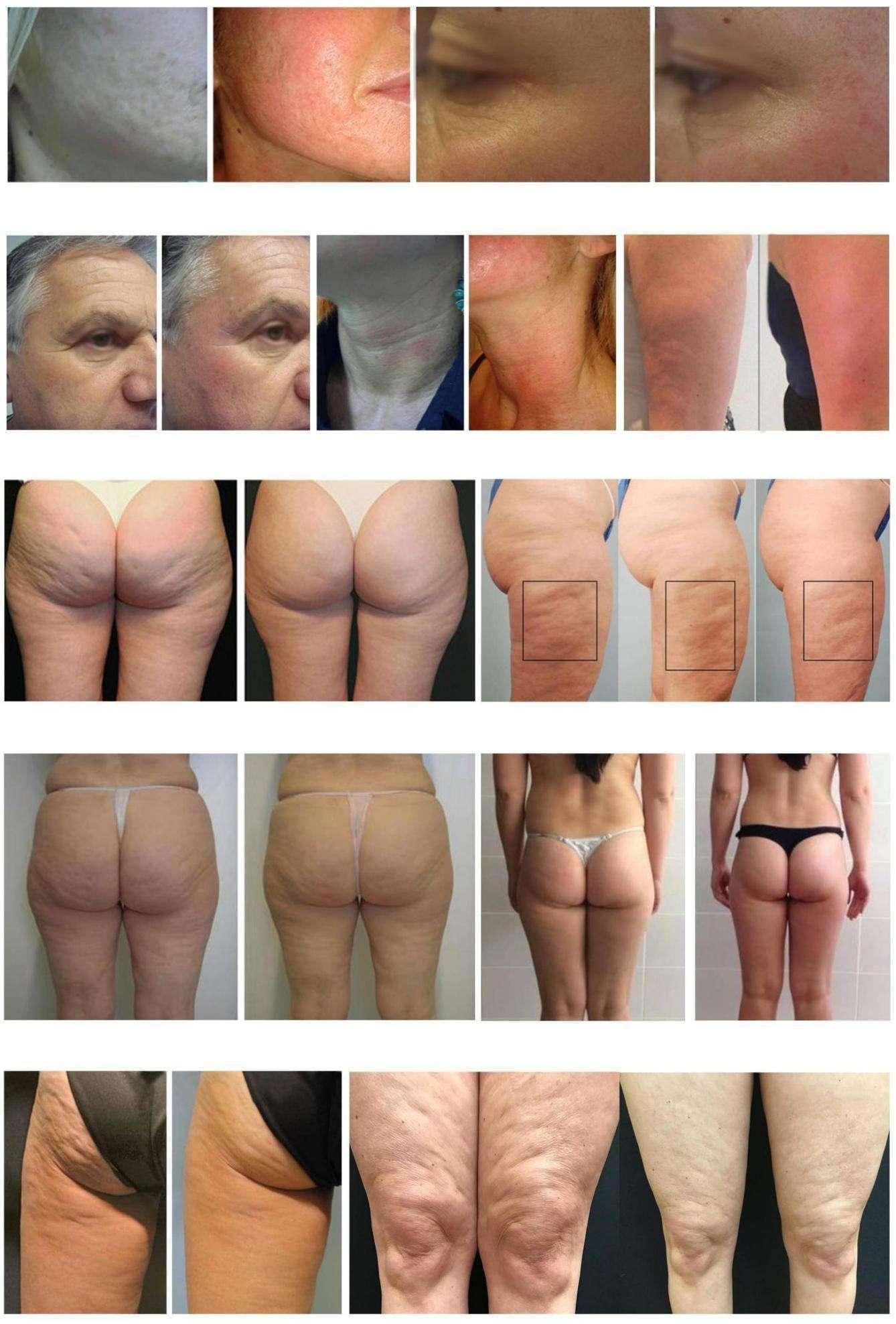 All In One 10D Slimming Roller Laser Equipment With Biolight Technology For Clinics And Spas