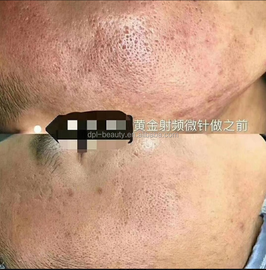 Wrinkle Removal RF Fractional Microneedling Machine Face Tightening With 25pins