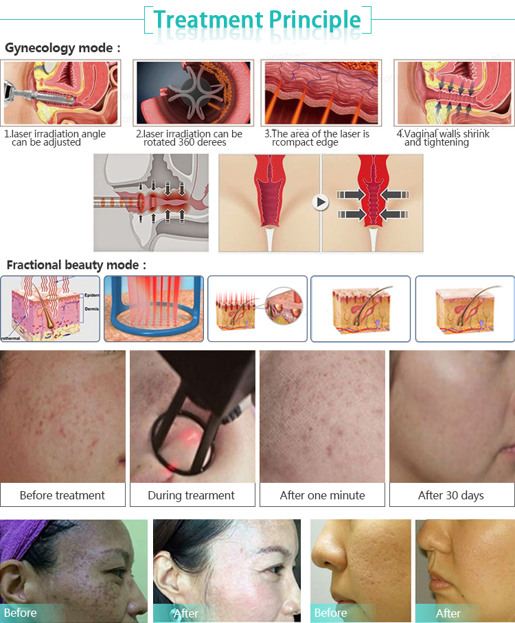 40 W high energy Best effect skin resurfacing erbium laser co2 laser 