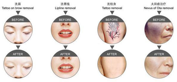1400MJ laser tatttoo removal machine
