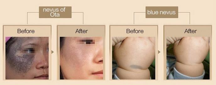 Picosecond q switched nd yag laser picosure q-switched tattoo removal laser machine