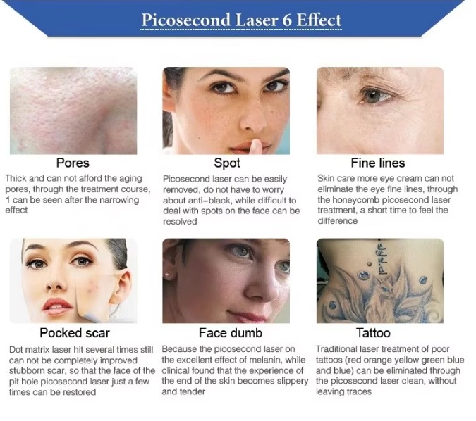 Carbon Laser Tattoo Removal Machine Pico Laser Spectra Q Switched Nd Yag Laser Picosegundos Picocare Lutron Pico Machine Price