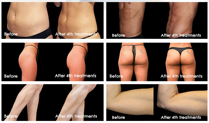 Emslim RF Pro 4 Handles Muscle Rebuilding Fat Loss Body Slimming