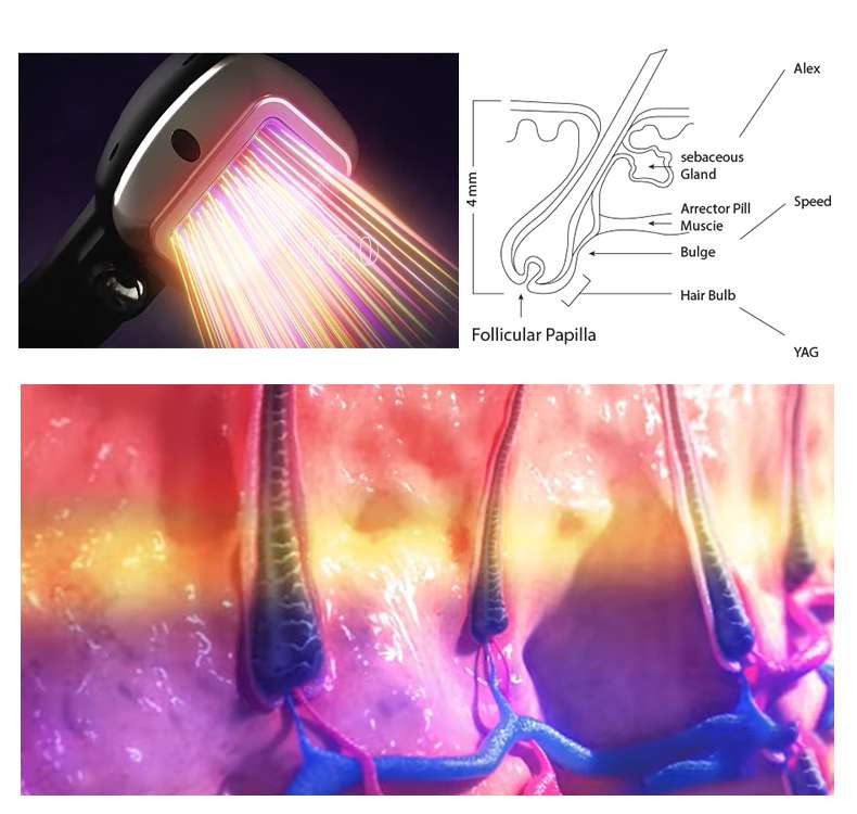 High Frequency Diode Depilation Laser Device With 10 Laser Bars Imported From Germany