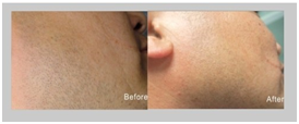 newest model amazing result ipl machine,ipl laser hair removal machine
