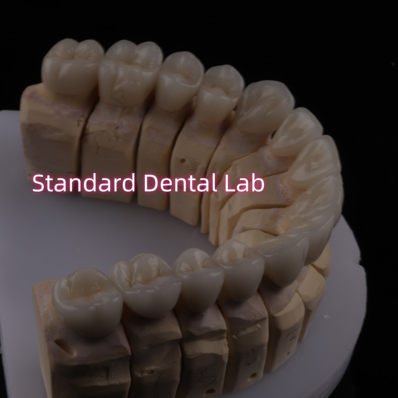 Digital CAD CAM Dental Lab PFZ Crowns Translucent Layered Zirconia Crown