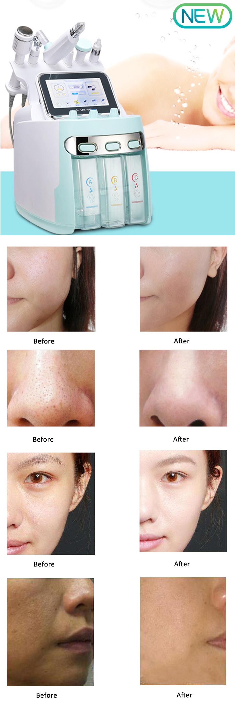 6 In 1 RF Body Slimming Machine H2O2 Hydra Facial Dermabrasion Vacuum Cavitation System