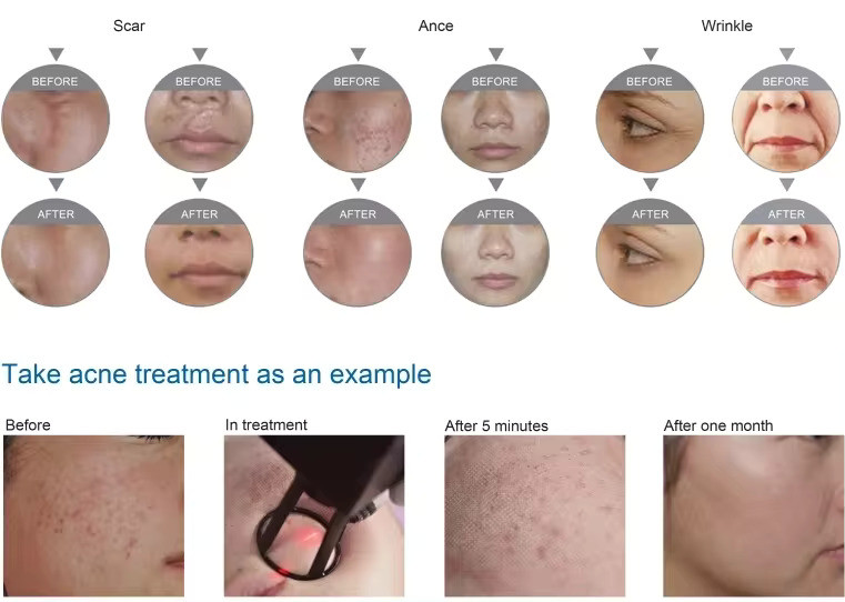 Continuous Interval Ultra Pulse RF Fractional CO2 Laser For Fractional Skin Resurfacing