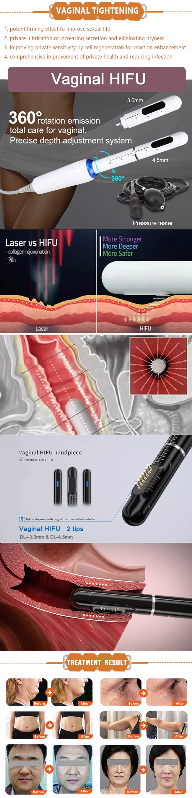 Korean Hifu Machine 2d 3d 4d 12 Lines Slimming Hifu For Face And Body