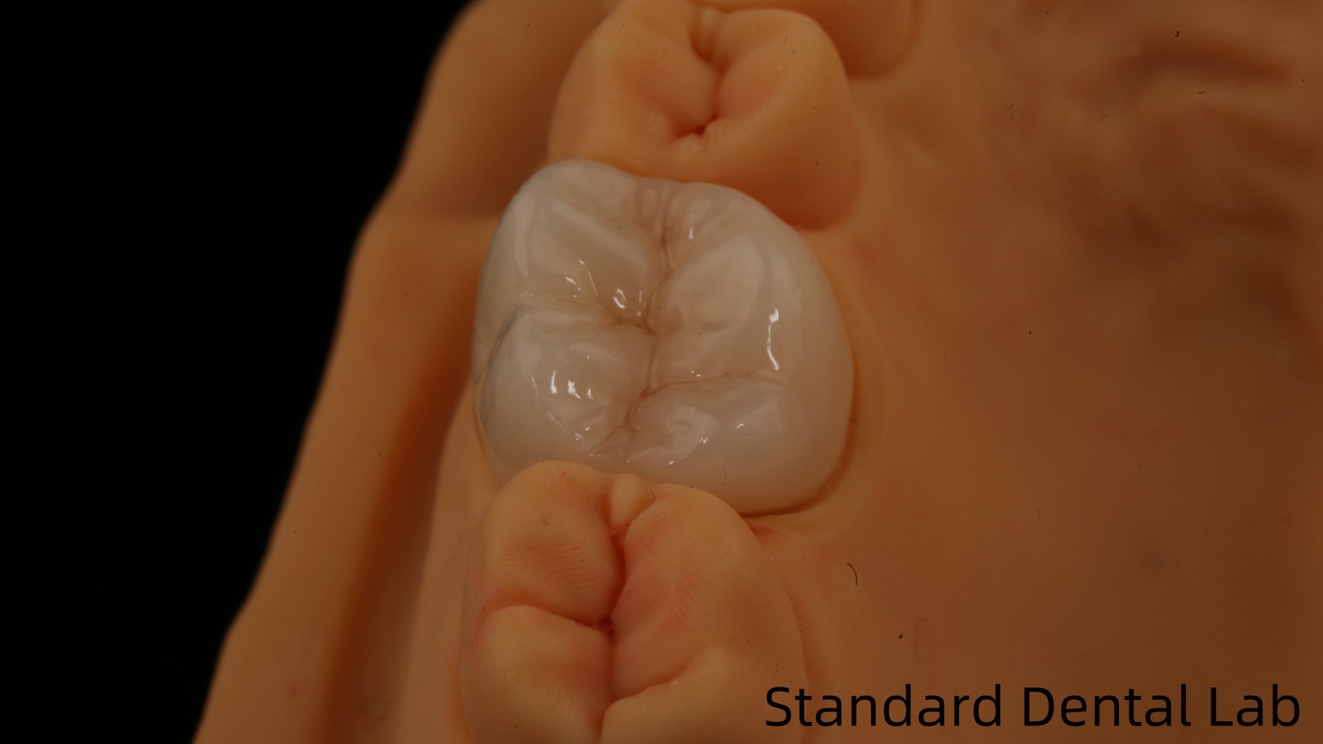 Noritake Porcelain Full Contour Zirconia Crown Customized Vita Shade for Esthetic Digital Dental Restoration by Dental Lab