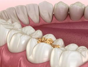  Gold Inlay Onlay Dental Crown High Noble Yellow Ni Be Free Manufactures
